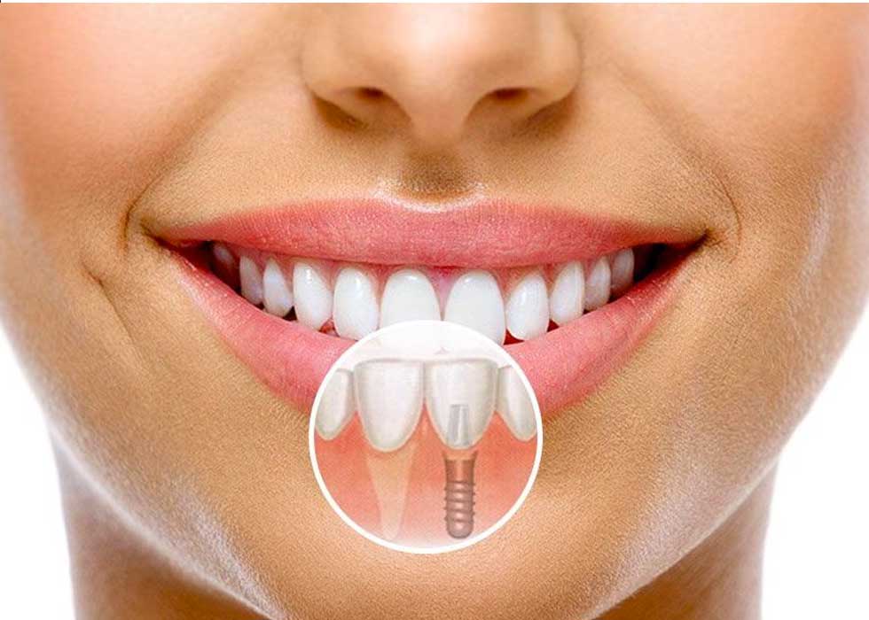 cay-ghep-implant-nha-khoa-le-vinh-4